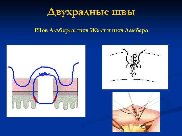 Двухрядные швы Шов Альберта: шов Жели и шов Ламбера 