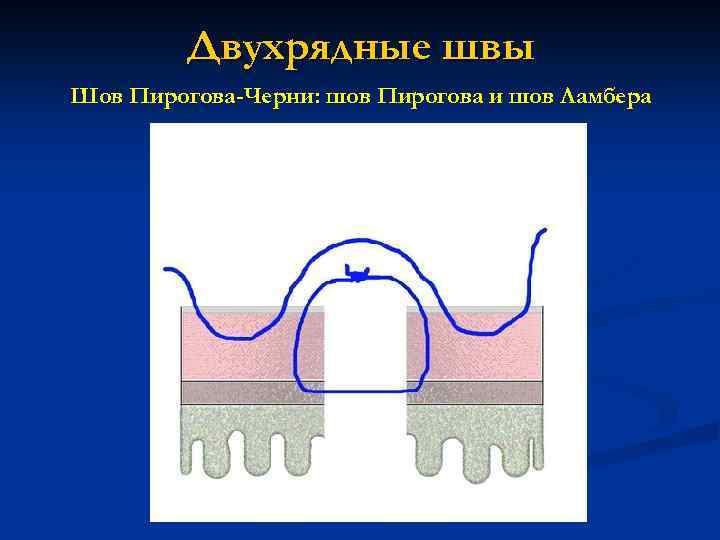 Двухрядные швы Шов Пирогова-Черни: шов Пирогова и шов Ламбера 