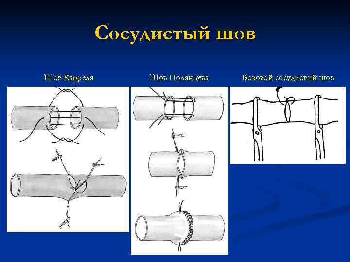 Сосудистый шов Шов Карреля Шов Полянцева Боковой сосудистый шов 