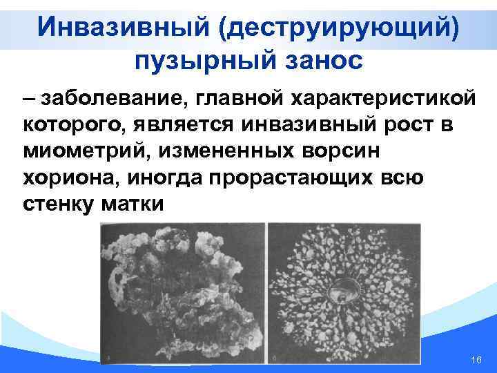 Инвазивный (деструирующий) пузырный занос – заболевание, главной характеристикой которого, является инвазивный рост в миометрий,