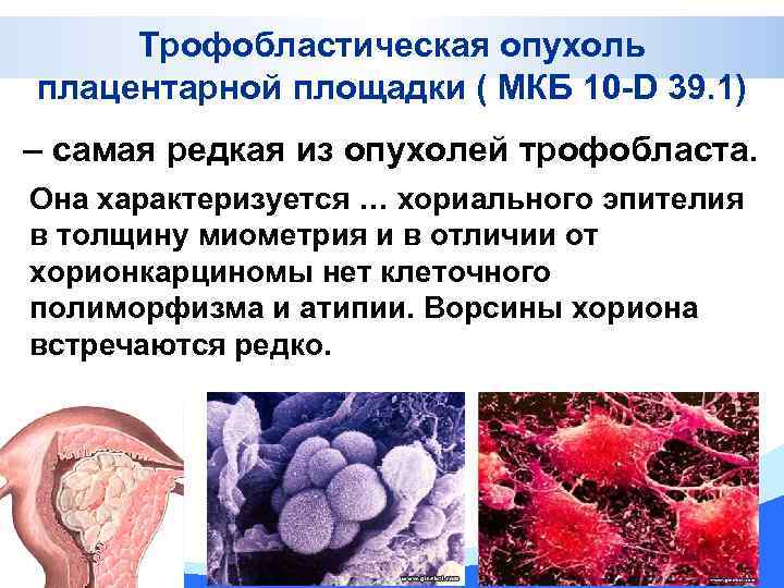 Трофобластическая опухоль плацентарной площадки ( МКБ 10 -D 39. 1) – самая редкая из