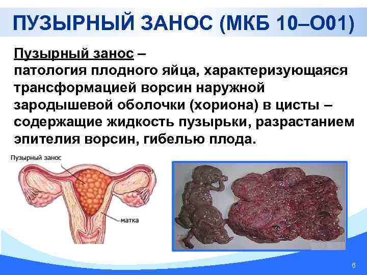 ПУЗЫРНЫЙ ЗАНОС (МКБ 10–О 01) Пузырный занос – патология плодного яйца, характеризующаяся трансформацией ворсин