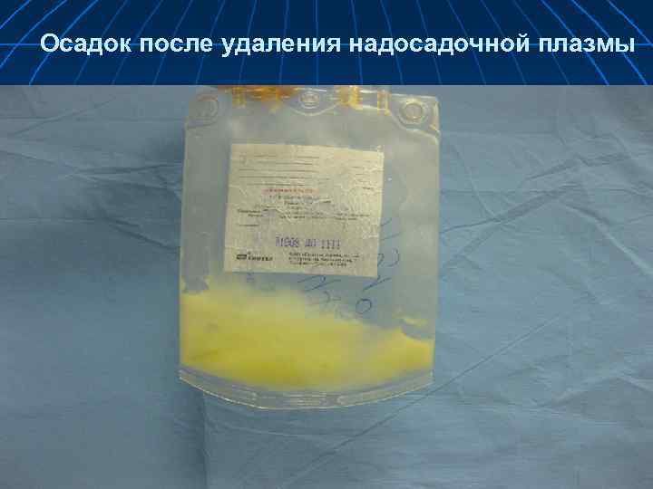 Осадок после удаления надосадочной плазмы 