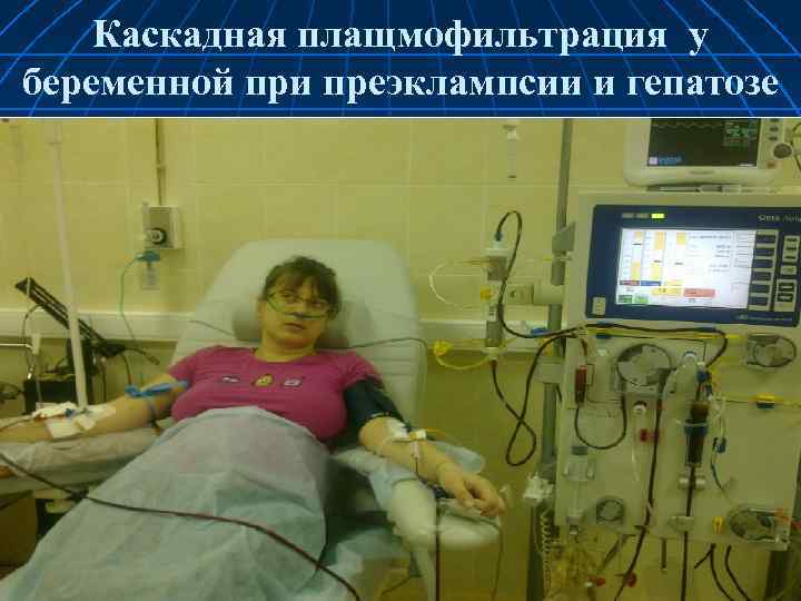 Каскадная плащмофильтрация у беременной при преэклампсии и гепатозе 