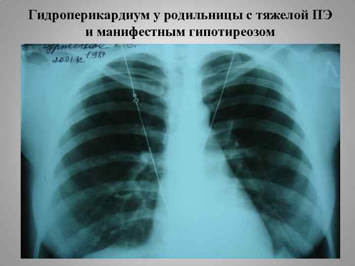 Гидроперикардиум у родильницы с тяжелой ПЭ и манифестным гипотиреозом 