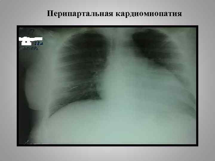 Перипартальная кардиомиопатия 