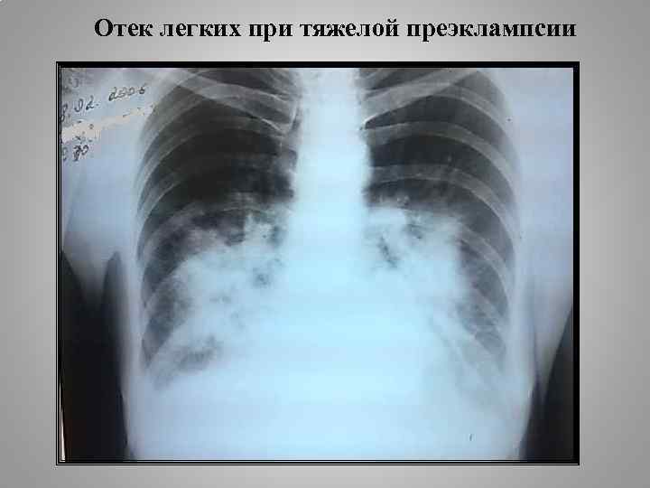 Отек легких при тяжелой преэклампсии 