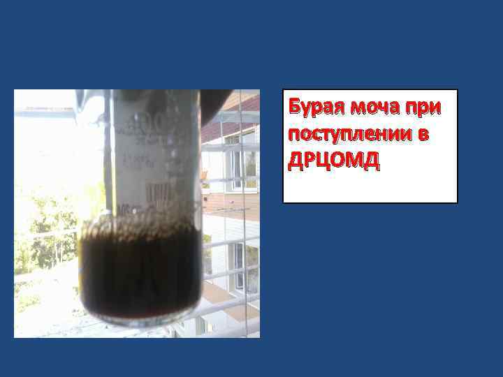 Бурая моча при поступлении в ДРЦОМД 