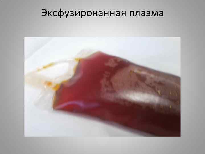 Эксфузированная плазма 
