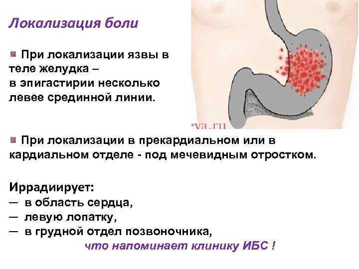 Локализация боли При локализации язвы в теле желудка – в эпигастирии несколько левее срединной