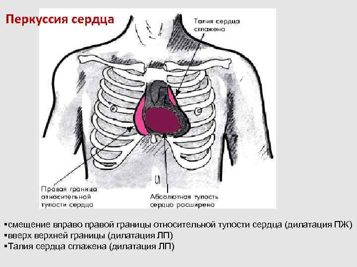 Перкуссия абсолютной тупости сердца