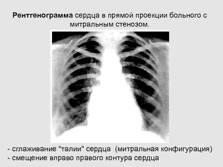 Рентгенограмма сердца в прямой проекции больного с митральным стенозом. - сглаживание 