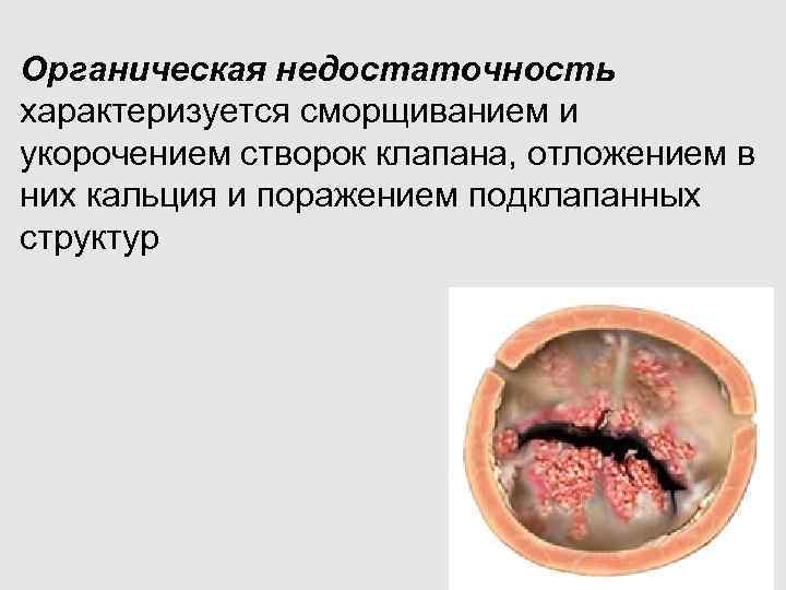 Органическая недостаточность характеризуется сморщиванием и укорочением створок клапана, отложением в них кальция и поражением