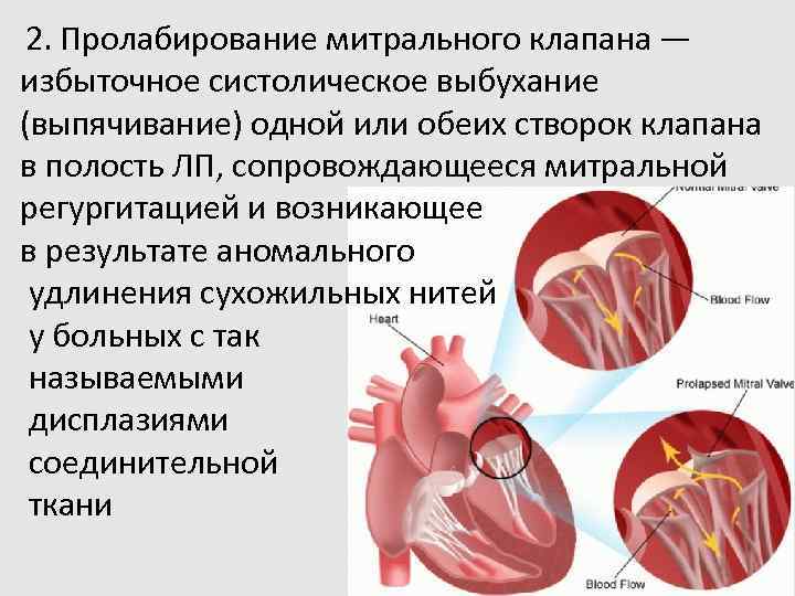 Митральный клапан сердца. Пролабирование передней створки митрального клапана. Пролабирование митрального клапана норма. Пролабирование створок клапана это. Пролабирование створки митрального клапана.