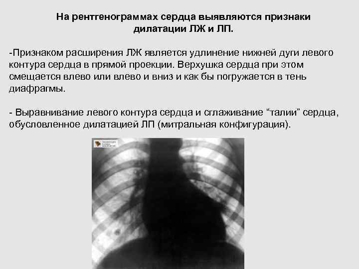 На рентгенограммах сердца выявляются признаки дилатации ЛЖ и ЛП. -Признаком расширения ЛЖ является удлинение