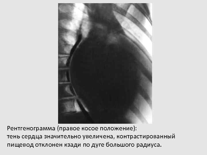 Рентгенограмма (правое косое положение): тень сердца значительно увеличена, контрастированный пищевод отклонен кзади по дуге