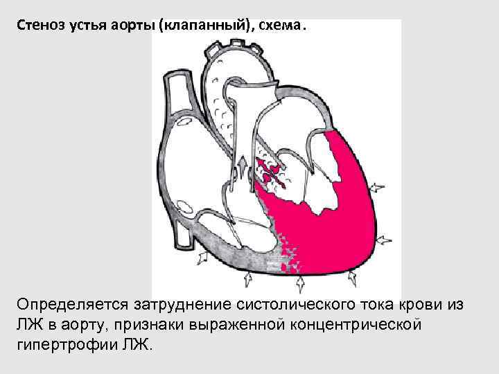 Клиническая картина пороков сердца