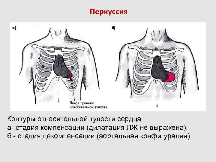 Перкуссия сердца презентация