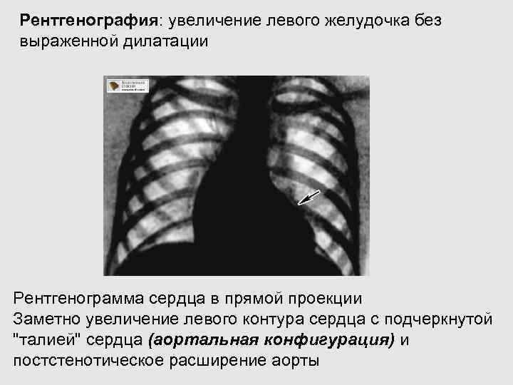 Рентгенография с прямым увеличением изображения применяется