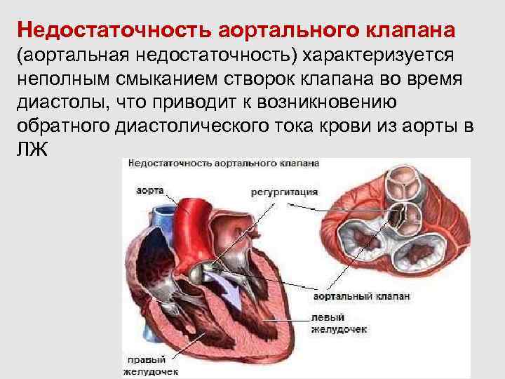 Недостаточность аортального клапана это