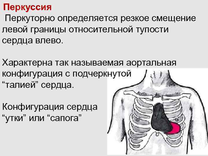 Перкуссия сердца презентация