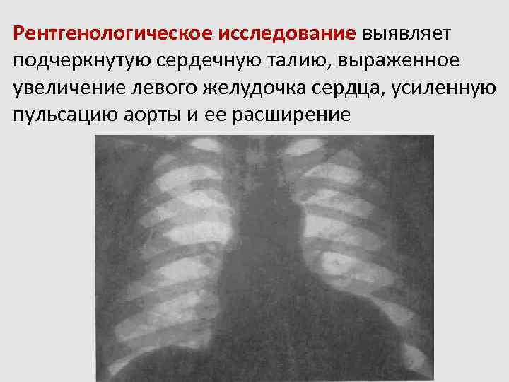 Аномалия это простыми. Рентгеноконтрастное исследование желудочков сердца. Увеличение левого желудочка сердца рентген животных. Пульсация аорты при открытом артериальном протоке на рентгене. На рентгене увеличено аорта и левый желудочек сердца.