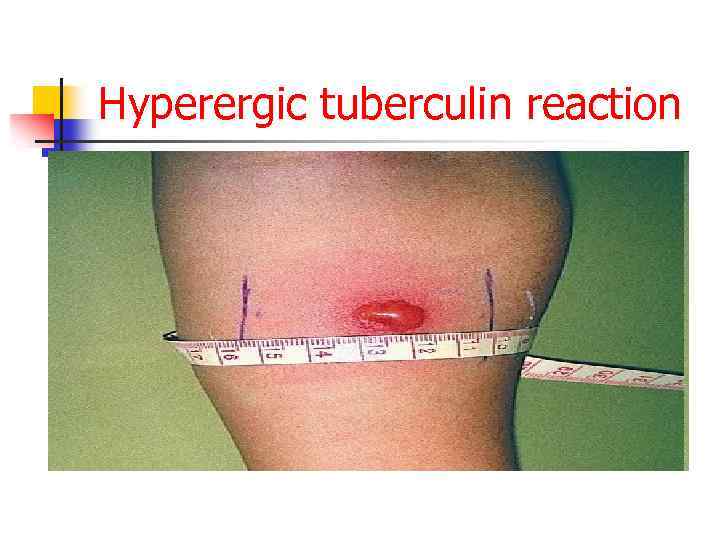 Hyperergic tuberculin reaction 