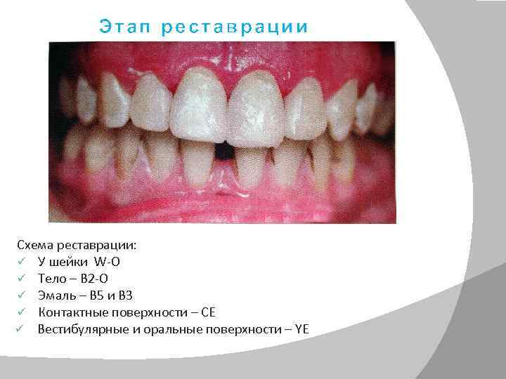 Этап реставрации Схема реставрации: ü У шейки W-O ü Тело – B 2 -O