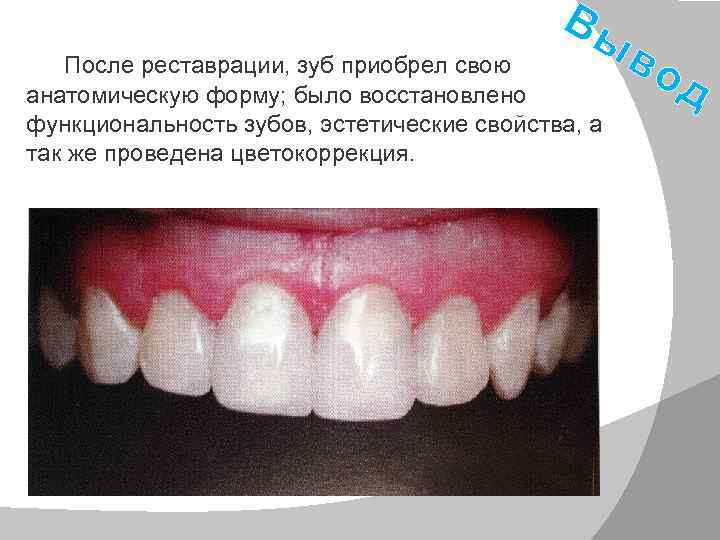  После реставрации, зуб приобрел свою Вы анатомическую форму; было восстановлено функциональность зубов, эстетические
