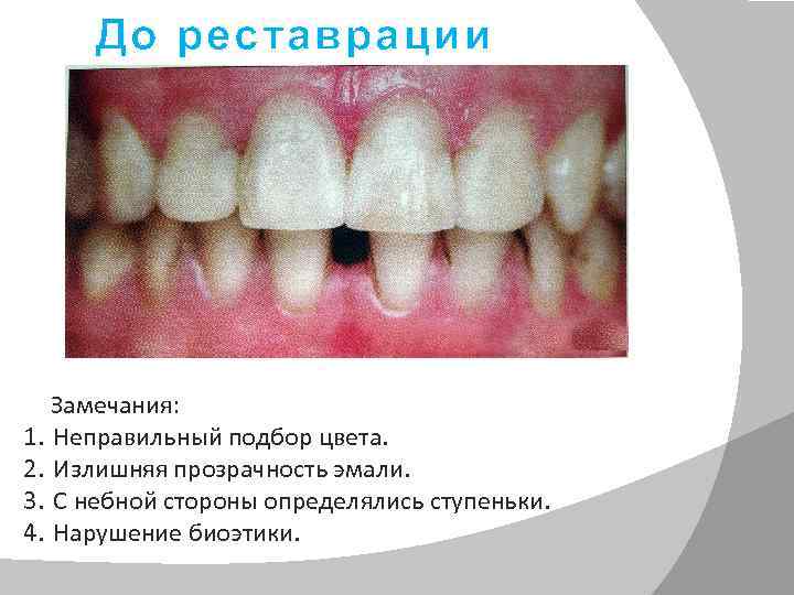 До реставрации Замечания: 1. 2. 3. 4. Неправильный подбор цвета. Излишняя прозрачность эмали. С