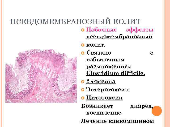 ПСЕВДОМЕМБРАНОЗНЫЙ КОЛИТ Побочные эффекты псевдомембранозный колит. Связано с избыточным размножением Closridium difficile. 2 токсина