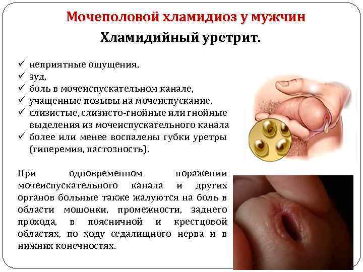 Мочеполовой хламидиоз у мужчин Хламидийный уретрит. неприятные ощущения, зуд, боль в мочеиспускательном канале, учащенные