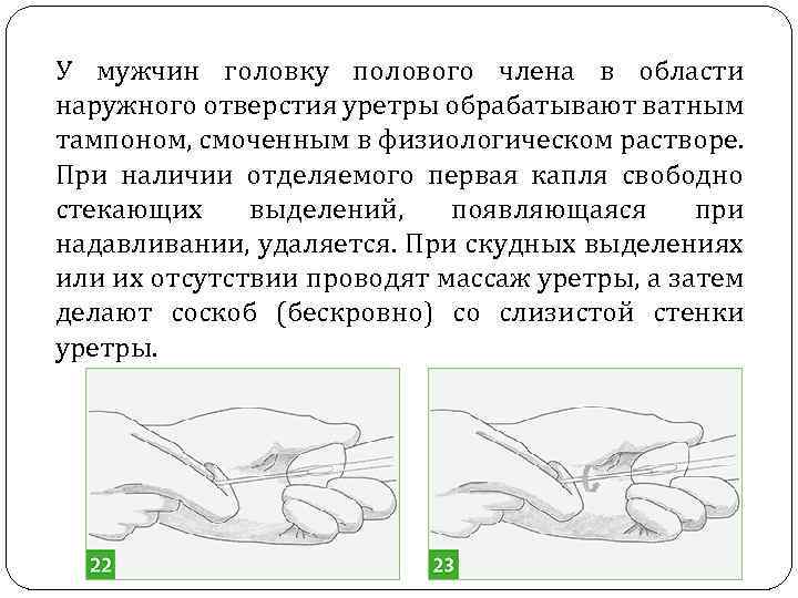 У мужчин головку полового члена в области наружного отверстия уретры обрабатывают ватным тампоном, смоченным