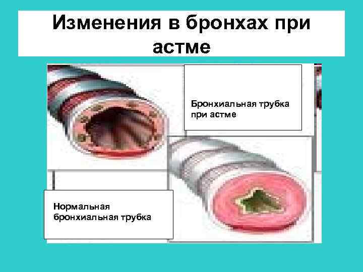 Изменения в бронхах при астме Бронхиальная трубка при астме Нормальная бронхиальная трубка 