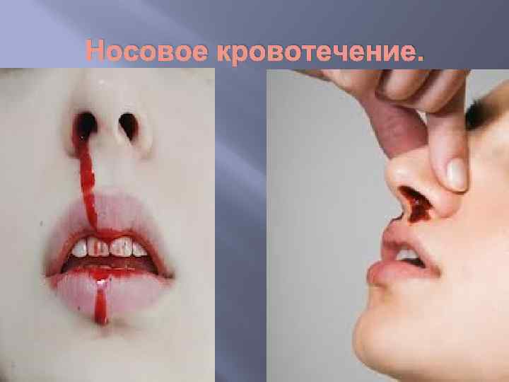 Носовое кровотечение. 