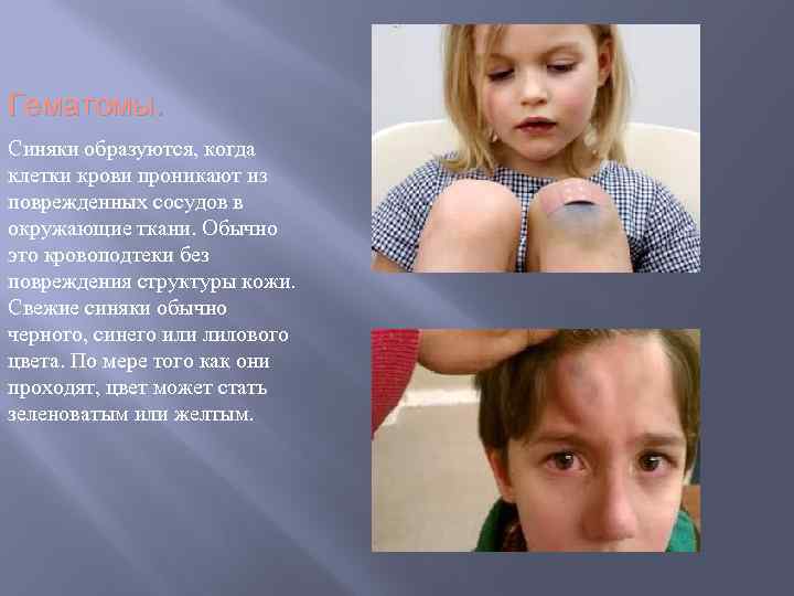 Гематомы. Синяки образуются, когда клетки крови проникают из поврежденных сосудов в окружающие ткани. Обычно