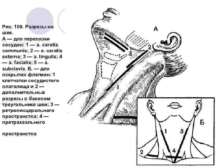 Рис. 109. Разрезы на шее. А — для перевязки сосудов: 1 — a. carotis