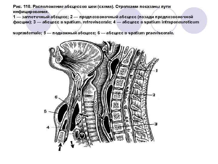 Рис. 110. Расположение абсцессов шеи (схема). Стрелками показаны пути инфицирования. 1 — заглоточный абсцесс;