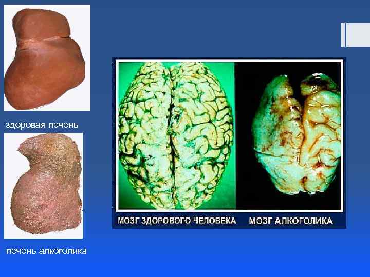 здоровая печень алкоголика 
