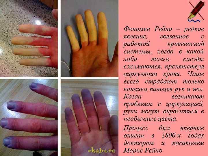  • Феномен Рейно – редкое явление, связанное с работой кровеносной системы, когда в