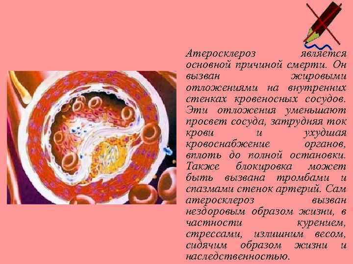 Атеросклероз является основной причиной смерти. Он вызван жировыми отложениями на внутренних стенках кровеносных сосудов.