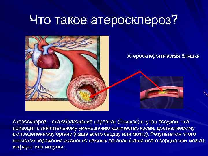 Что такое атеросклероз? Атеросклеротическая бляшка Атеросклероз – это образование наростов (бляшек) внутри сосудов, что