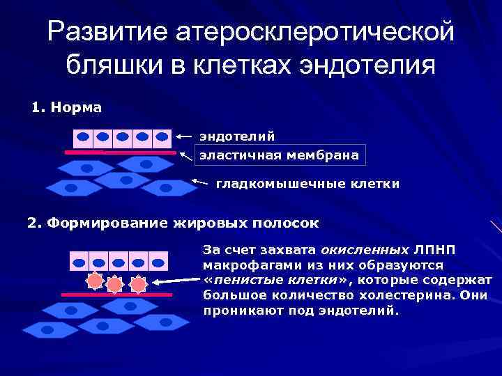 Развитие атеросклеротической бляшки в клетках эндотелия 1. Норма эндотелий эластичная мембрана гладкомышечные клетки 2.