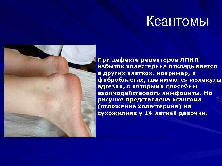 Ксантомы При дефекте рецепторов ЛПНП избыток холестерина откладывается в других клетках, например, в фибробластах,