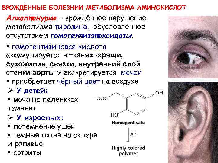 ВРОЖДЁННЫЕ БОЛЕЗНИИ МЕТАБОЛИЗМА АМИНОКИСЛОТ Алкаптонурия – врождённое нарушение метаболизма тирозина, обусловленное отсутствием гомогентизатоксидазы. §