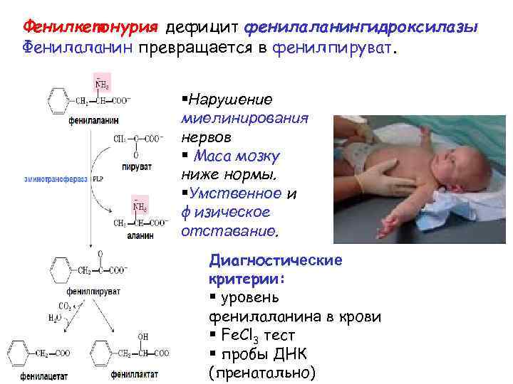 Фенилкетонурия биохимия