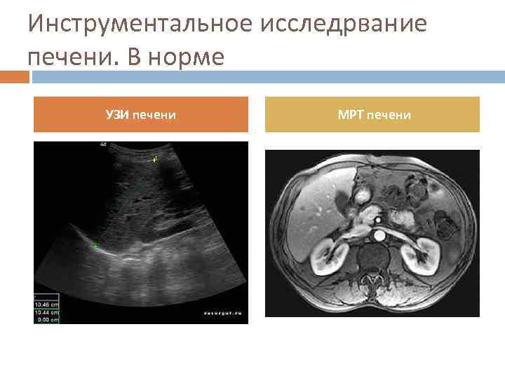 Инструментальное исследрвание печени. В норме УЗИ печени МРТ печени 