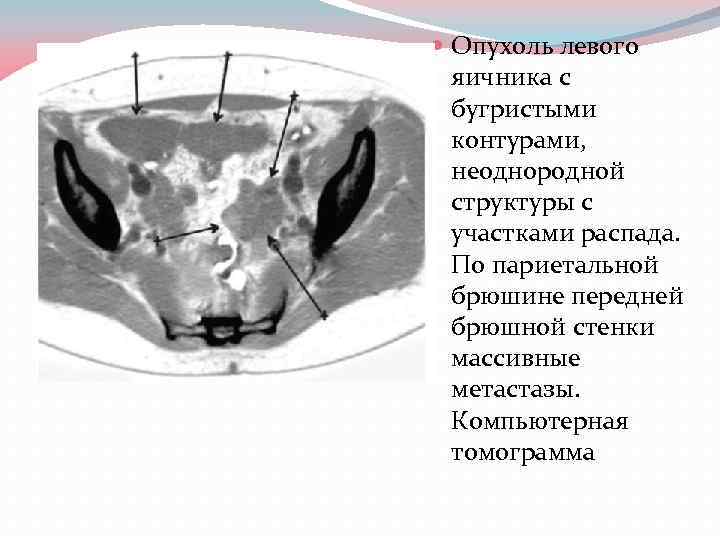 Неоднородные яичники. Новообразование на брюшине. Объемное образование передней брюшной стенки. Опухоль передней брюшной стенки.