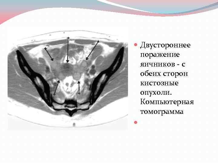  Двустороннее поражение яичников - с обеих сторон кистозные опухоли. Компьютерная томограмма 