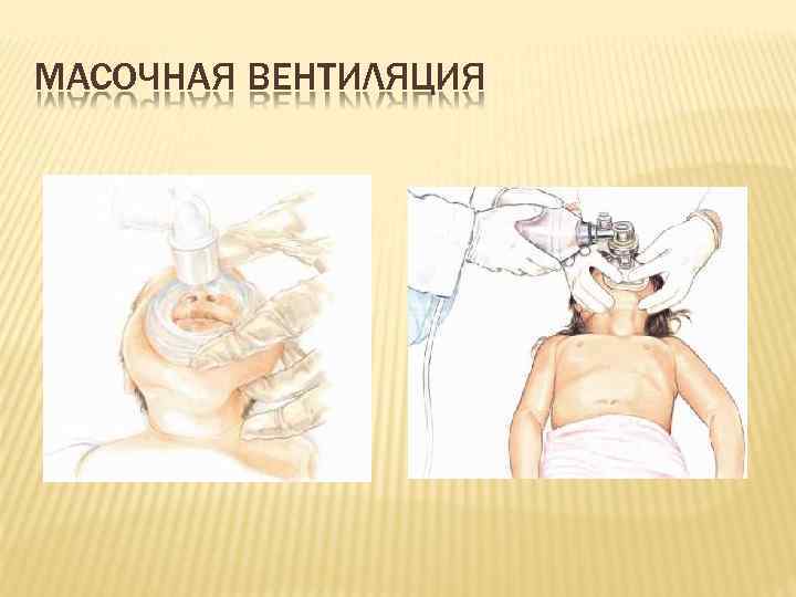 МАСОЧНАЯ ВЕНТИЛЯЦИЯ 